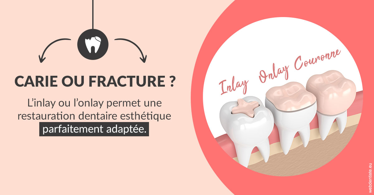 https://www.centre-dentaire-asnieres-les-gresillons.fr/T2 2023 - Carie ou fracture 2