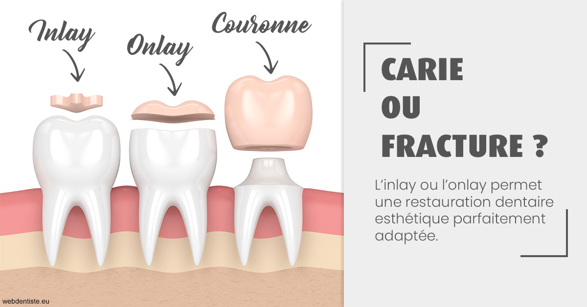 https://www.centre-dentaire-asnieres-les-gresillons.fr/T2 2023 - Carie ou fracture 1