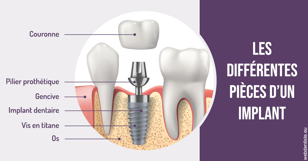 https://www.centre-dentaire-asnieres-les-gresillons.fr/Les différentes pièces d’un implant 2