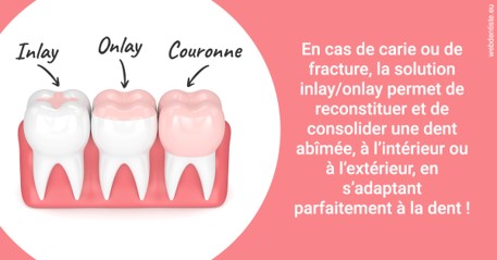 https://www.centre-dentaire-asnieres-les-gresillons.fr/L'INLAY ou l'ONLAY 2