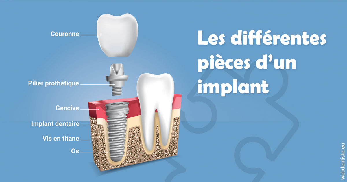 https://www.centre-dentaire-asnieres-les-gresillons.fr/Les différentes pièces d’un implant 1